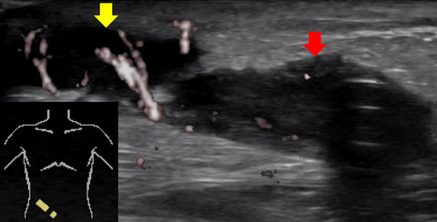 Importance of ultrasound examination: A case of peritoneal catheter tunnel infection