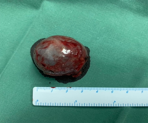 Splenosis mimicking gastric obstructive tumor: Diagnostic workup and surgical excision