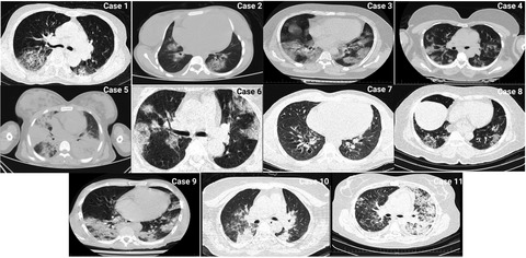 Clinically suspected myocarditis in COVID‐19 patients: Case series and review of the literature