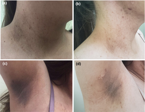 Cobalamin F deficiency in a girl with severe skin hyperpigmentation and a homozygous LMBRD1 variant