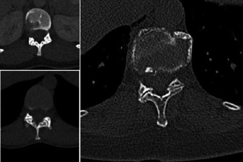 Vertebrae at the thoracolumbar junction: A quantitative assessment using CT scans