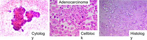 Categorisation of serous effusions using the International System for Reporting Serous Fluid Cytopathology and assessment of risk of malignancy with diagnostic accuracy