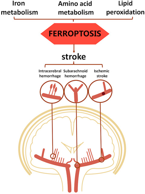 Ferroptosis: An emerging therapeutic target in stroke