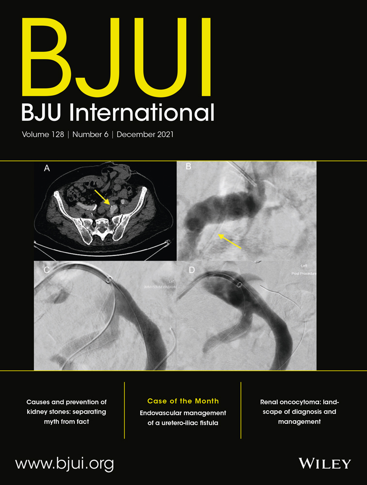 Lymphangioembolization for iatrogenic chylous ascites after retroperitoneal urologic surgery