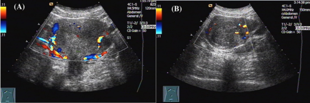 Analysis of high intensity focused ultrasound in treatment of uterine fibroids on ovarian function and pregnancy outcome