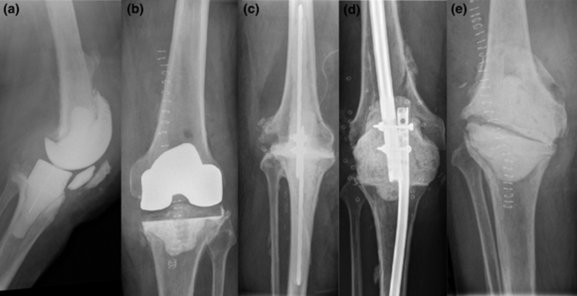 Repeat two‐stage revision for knee prosthetic joint infection results in very high failure rates