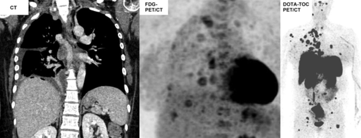 Rarest of rare cases within the one thousand faces of atypical carcinoid: Pseudomesotheliomatous manifestation in a pregnant woman