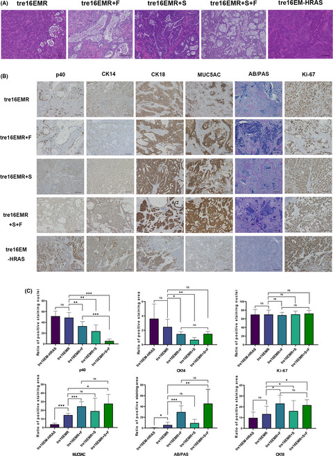 Development of an in vitro carcinogenesis model of human papillomavirus‐induced cervical adenocarcinoma
