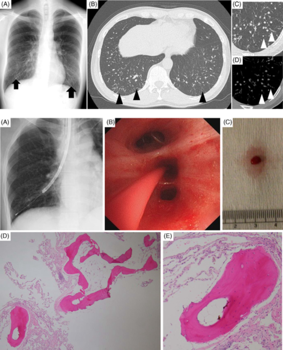Idiopathic dendriform pulmonary ossification diagnosed by bronchoscopic lung cryobiopsy: A case report