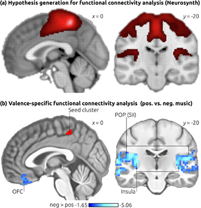 Tormenting thoughts: The posterior cingulate sulcus of the default mode network regulates valence of thoughts and activity in the brain's pain network during music listening