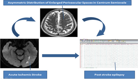 Asymmetric distribution of enlarged perivascular spaces in centrum semiovale may be associated with epilepsy after acute ischemic stroke