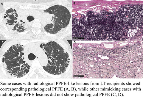 Clinical, radiological and pathological features of idiopathic and secondary interstitial pneumonia with pleuroparenchymal fibroelastosis in patients undergoing lung transplantation