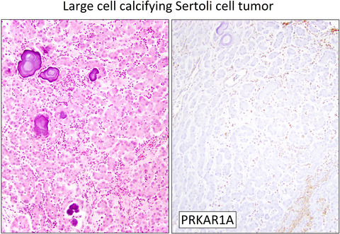 Large cell calcifying Sertoli cell tumour: a contemporary multi‐institutional case series highlighting the diagnostic utility of PRKAR1A immunohistochemistry