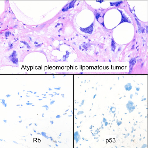 Well‐differentiated lipomatous neoplasms with p53 alterations: a clinicopathological and molecular study of eight cases with features of atypical pleomorphic lipomatous tumour