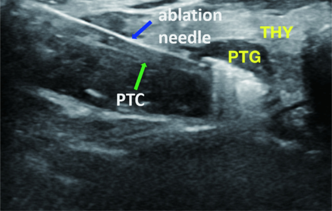 Evaluation of efficacy of ultrasound‐guided microwave ablation in primary hyperparathyroidism