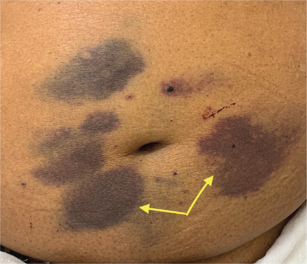 Anterior Abdominal Wall Ecchymosis in COVID-19 Patient Following Enoxaparin Use