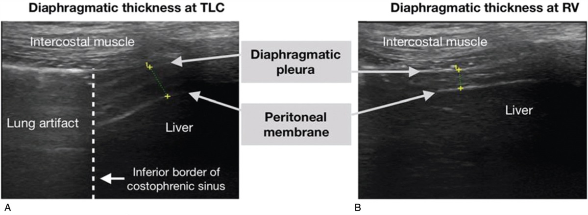 Diaphragmatic Function Assessment Using Chest Ultrasonography as a Predictor for Weaning from Mechanical Ventilation