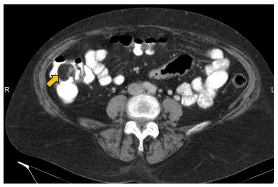 Gastroenterology Insights, Vol. 13, Pages 173-181: Hydrocolonic Sonography: Description of the Technique and Its Application in a Case of Intracolonic Lipoma: Report about a Case