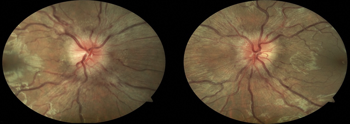 Vision Preservation in COVID-Related Cerebral Sinovenous Thrombosis With Optic Nerve Sheath Fenestration