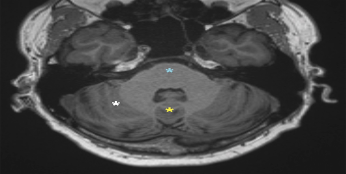 A Case of Opsoclonus-Myoclonus-Ataxia With Neuronal Intermediate Filament IgG Detected in Cerebrospinal Fluid