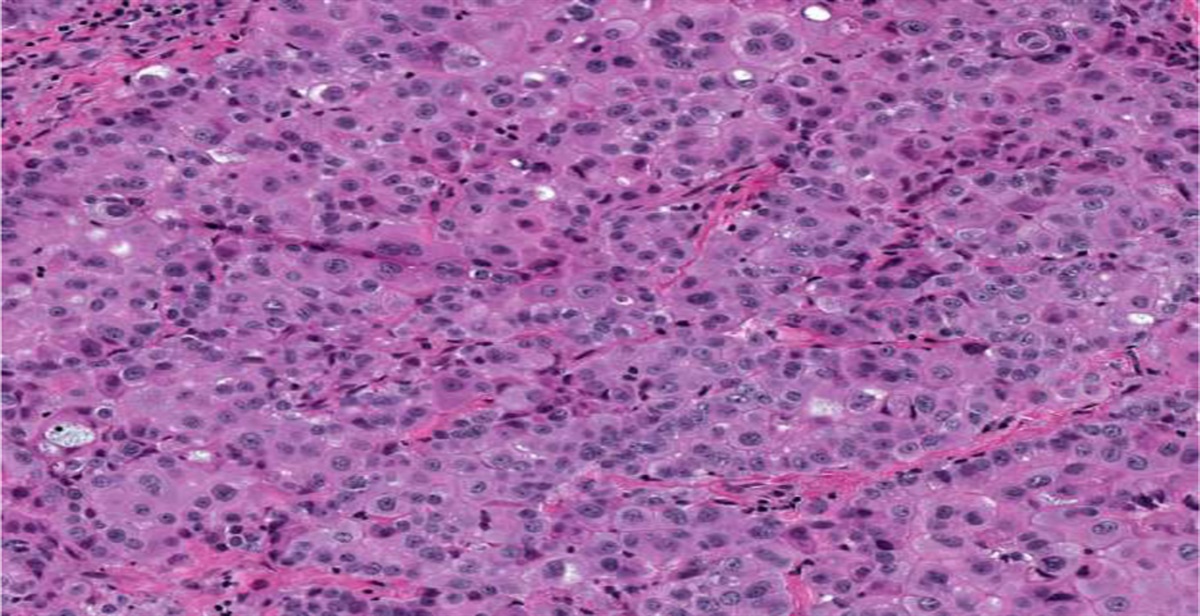 Immunohistochemical Pitfalls in Malignant Peritoneal Mesothelioma: A Case Report and Review for the General Pathologist