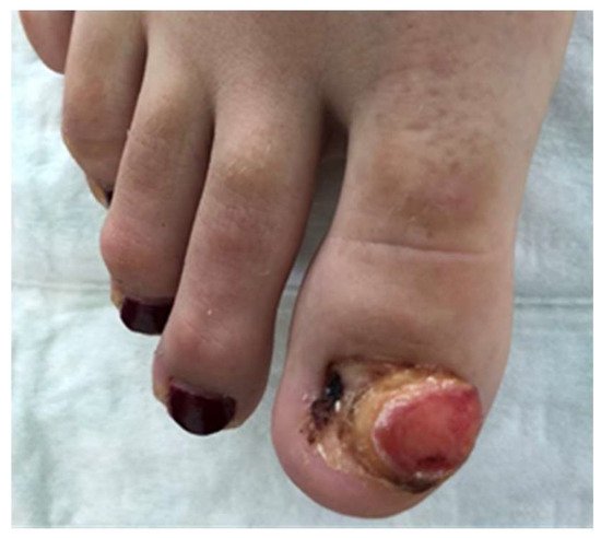 Dermatopathology, Vol. 9, Pages 196-202: Subungual Exostosis Presenting as a Pyogenic Granuloma-like Lesion with Reactive Myofibroblastic Proliferation in Two Young Women