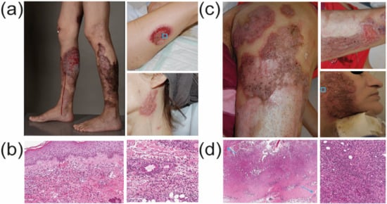 Dermatopathology, Vol. 9, Pages 207-211: Cocaine/Levamisole-Induced, Skin-Limited ANCA-Associated Vasculitis with Pyoderma Gangrenosum-Like Presentation