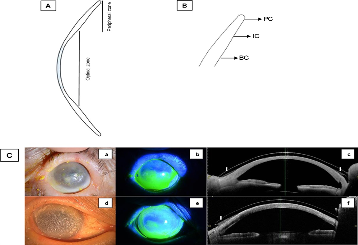 Limbal-Rigid Contact Lens Wear for the Treatment of Ocular Surface Disorders: A Review