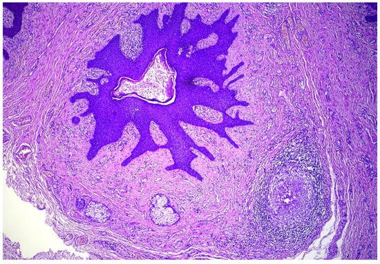 Dermatopathology, Vol. 9, Pages 277-281: Genital Folliculosebaceous Cystic Hamartoma: A Case Report and Concise Review of the Literature