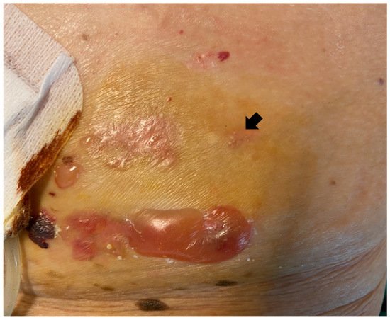 Dermatopathology, Vol. 9, Pages 282-286: Blisters and Milia around the Peritoneal Dialysis Catheter: A Case of Localized Bullous Pemphigoid