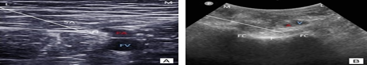 Adding Dexamethasone to Adductor Canal Block Combined With iPACK Block Improve Postoperative Analgesia of Total Knee Arthroplasty