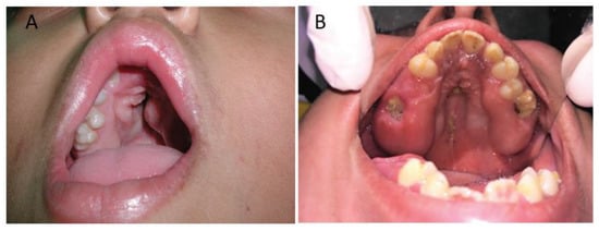 JDB, Vol. 10, Pages 33: Cleft Palate in Apert Syndrome