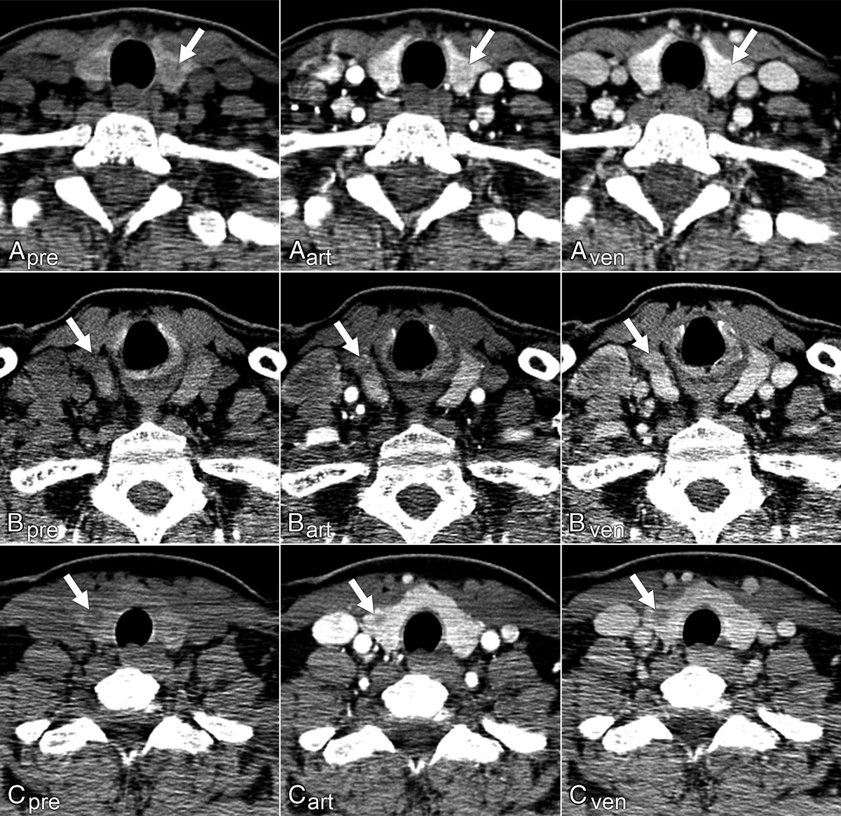 Distinguishing Intrathyroid Parathyroid Adenoma from Colloid Nodules and Papillary Thyroid Carcinomas Using Multiphasic Multidetector Computed Tomography