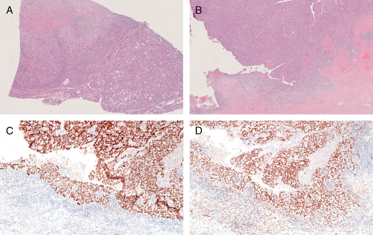 Carcinomas With Concurrent Involvement of the Endometrium and Uterine Adnexa—Implications for Pathological Diagnosis and Clinical Management in Current Practice
