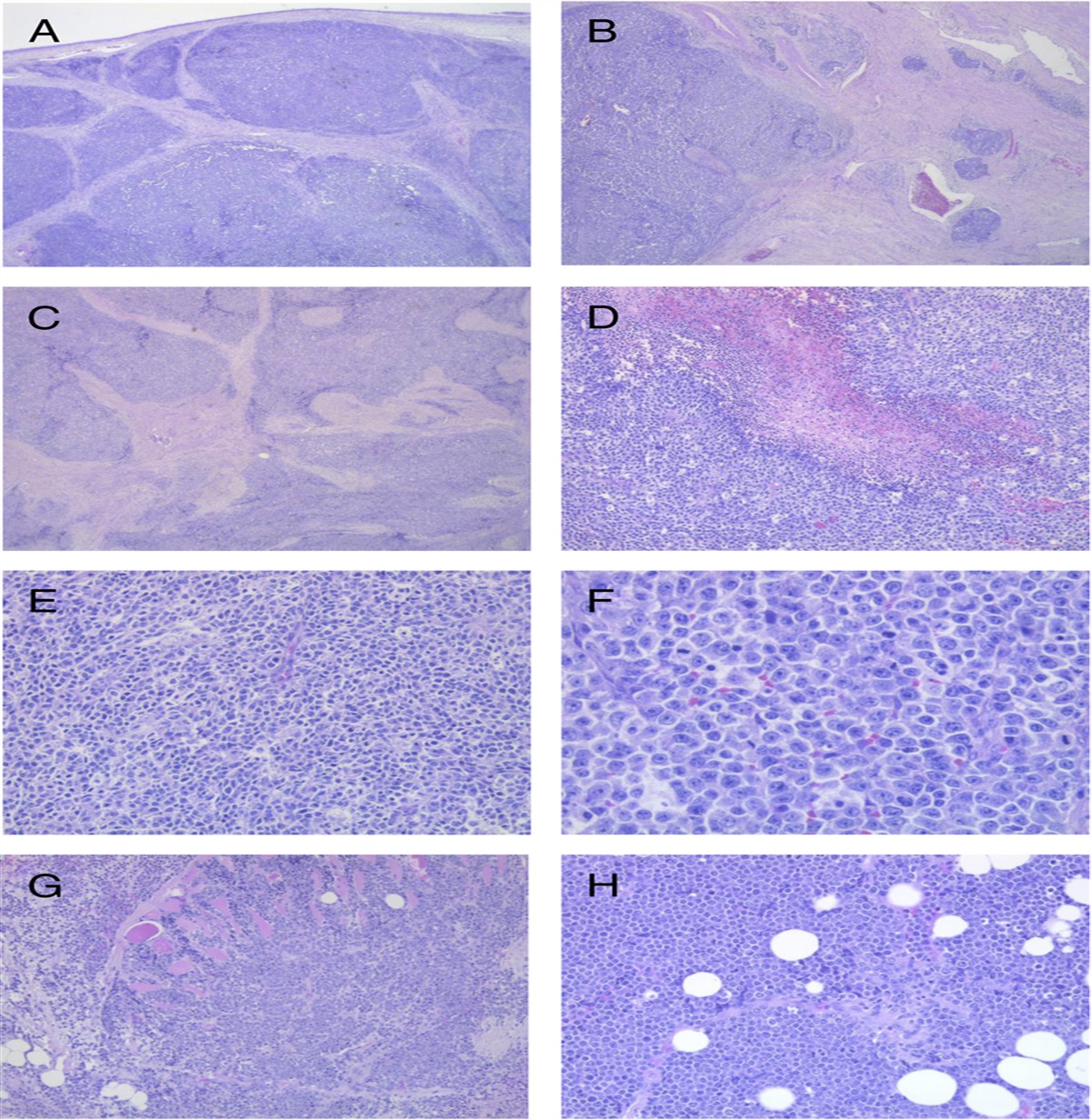 Undifferentiated Endometrial Carcinoma—Diagnostic and Therapeutic Challenges