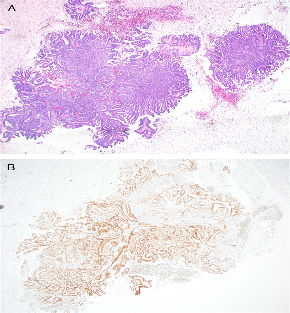 Mesonephric-Like Adenocarcinoma of the Endometrium: Review of the Literature and Practical Diagnostic Recommendations