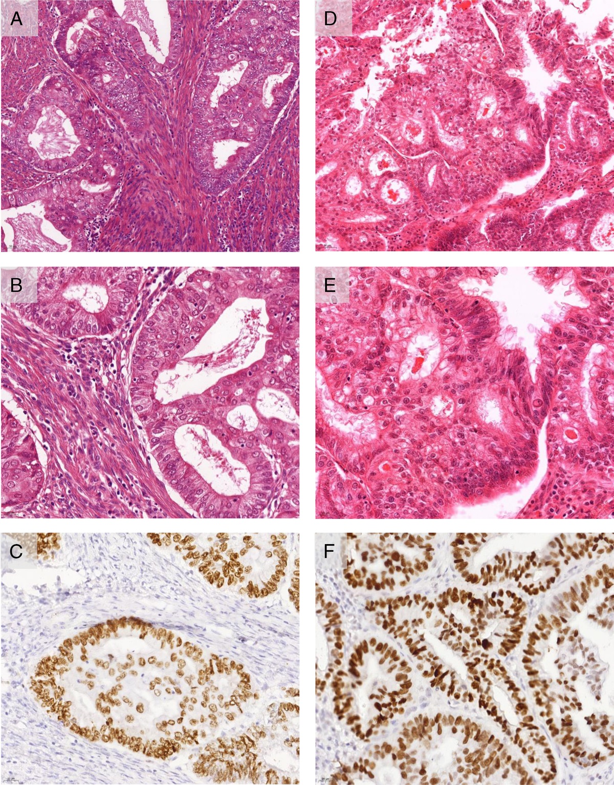 The Best of Both Worlds: Combining the Molecular and Traditional (Histotype/Grade) Endometrial Cancer Classification