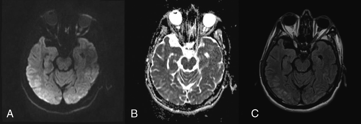 Posterior Reversible Encephalopathy Syndrome Occurred During the Use of Pseudoephedrine: A Case Report
