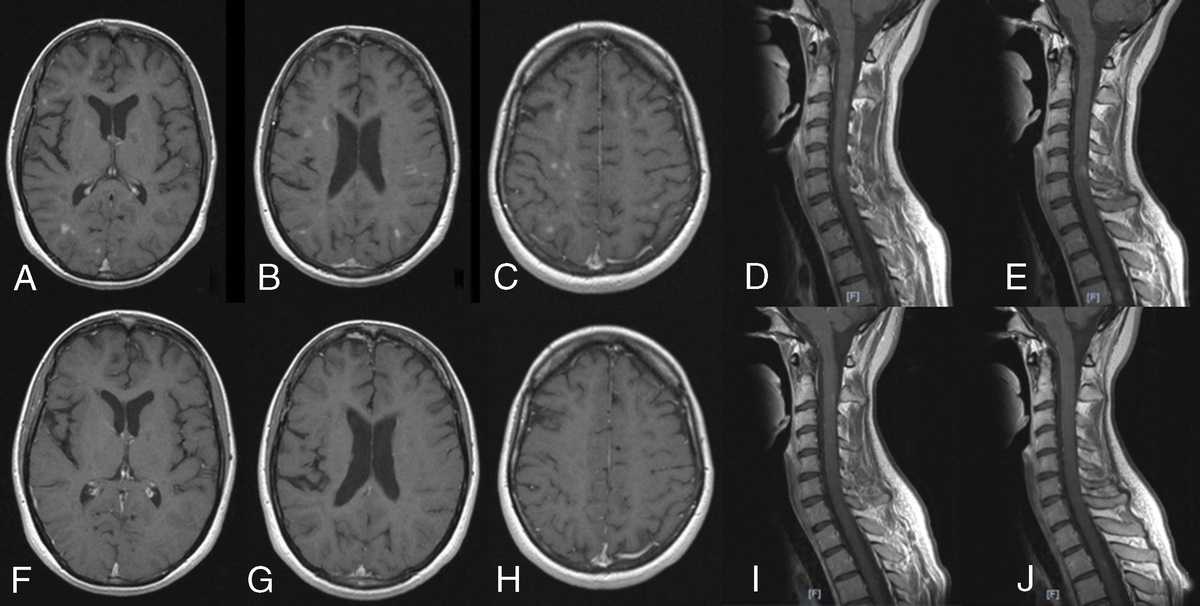 Ocrelizumab for Post-Alemtuzumab Paradoxical Disease Activity in Highly Active Multiple Sclerosis