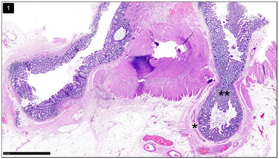 Gastroenterology Insights, Vol. 13, Pages 326-339: Diverticular Disease—An Updated Management Review