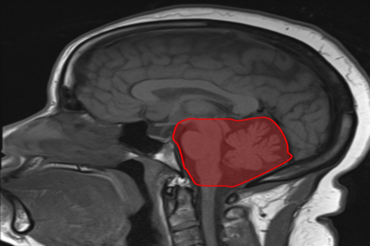 Case Report: Asymptomatic Skew Deviation Secondary to Chronic Ischemic Infarction of the Cerebellum