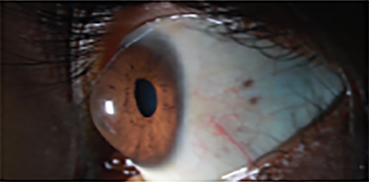 The Value of Eccentric Infrared Photorefraction in Evaluating Keratoconus