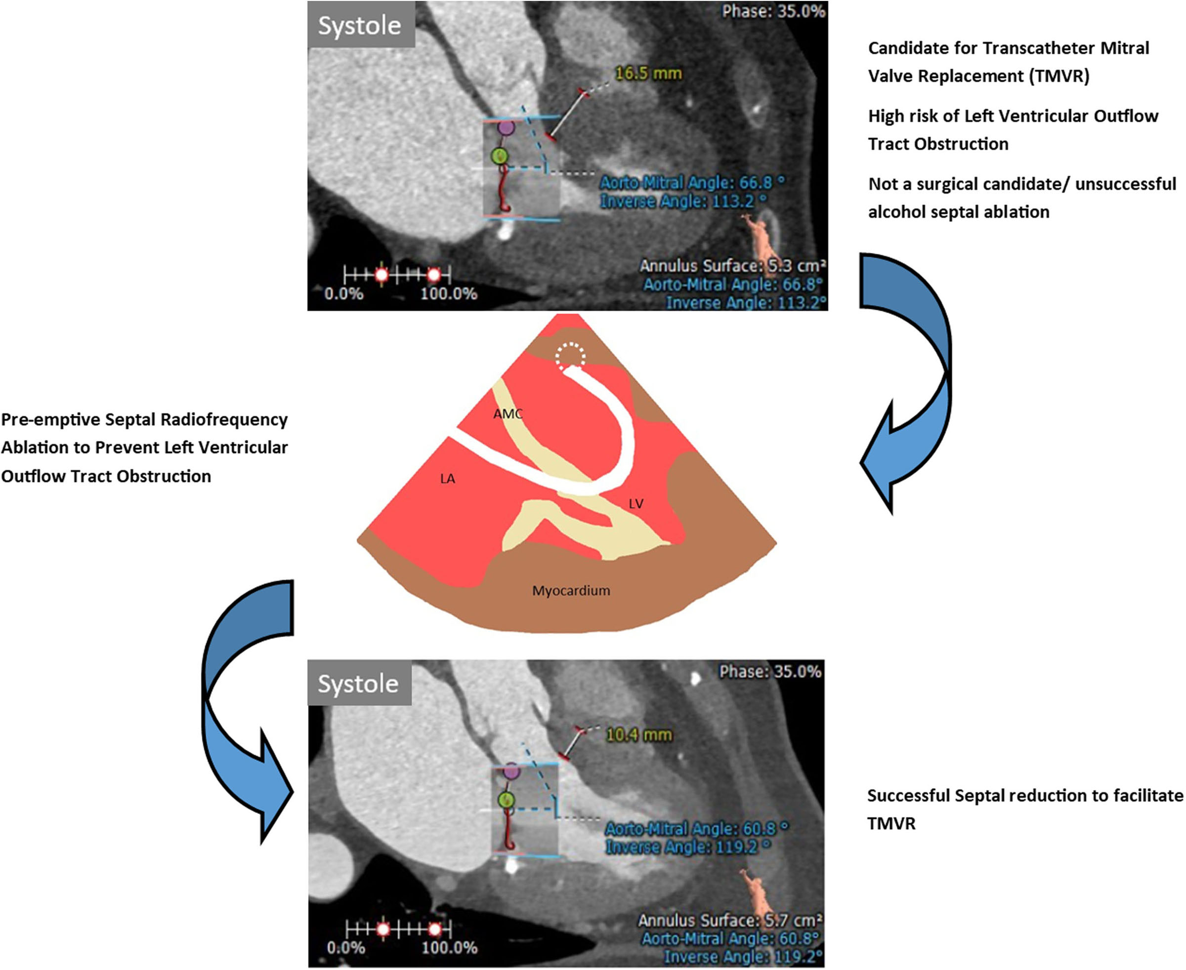 Preemptive Septal Radiofrequency Ablation to Prevent Left Ventricular Outflow Tract Obstruction With Transcatheter Mitral Valve Replacement: A Case Series