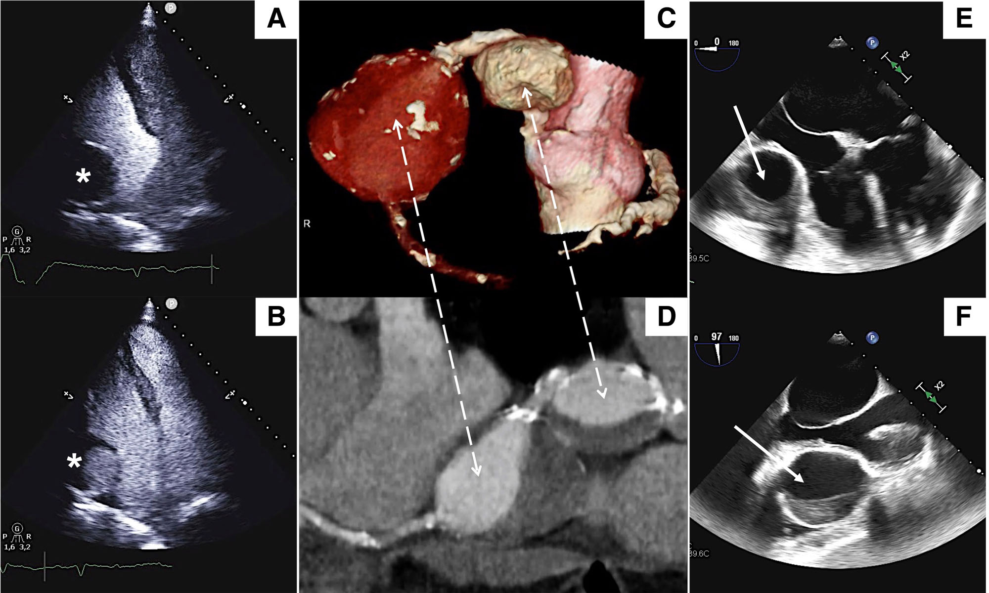 Pericardial Cyst or Something Else? Do Not Forget Echocontrast in the Drawer!