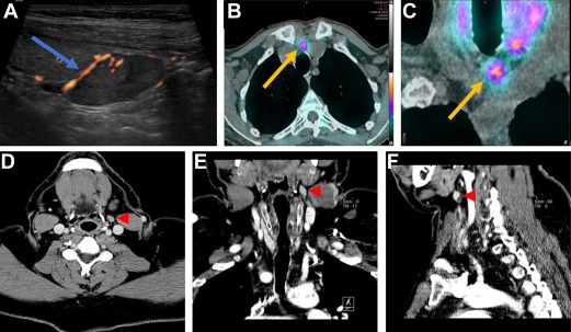 Advances in Endocrine Surgery