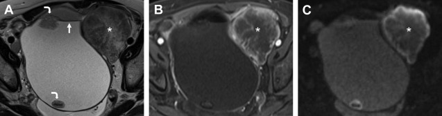 MR Imaging of Germ Cell and Sex Cord Stromal Tumors