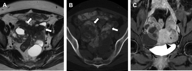 MR Imaging of Epithelial Ovarian Neoplasms Part II