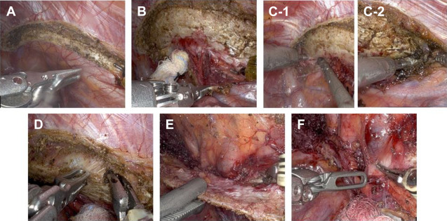 Robotic First Rib Resection and Robotic Chest Wall Resection