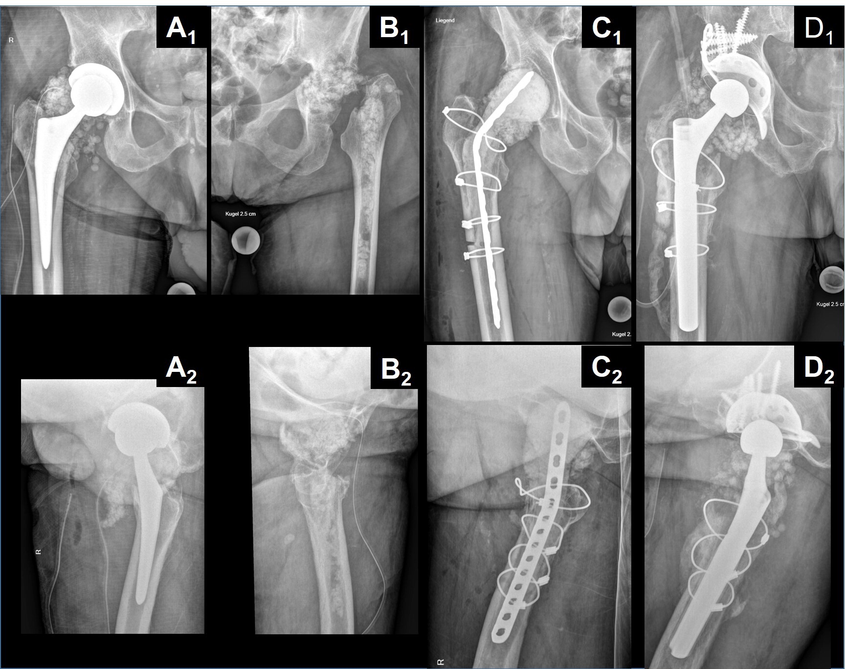 Wound fluid ceftriaxone concentrations after local application with calcium sulphate as carrier material in the treatment of orthopaedic device-associated hip infections