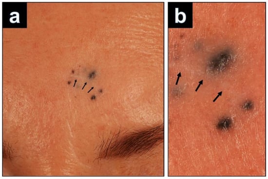Dermatopathology, Vol. 9, Pages 361-367: Recurrence of a Cellular Blue Nevus with Satellitosis—A Diagnostic Pitfall with Clinical Consequences